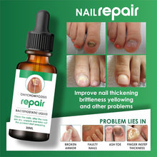 Load image into Gallery viewer, Fungi Nail Treatment, Fungi Nail Ointment , Onychomycosis Ointment, Nail Serum for Nail Fungus, Nail Repair Ointment, Anti-Infective Fungal Nail Removal, Fungal Infection Treatment, Nail Fungus Cream
